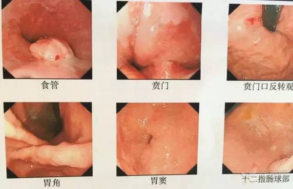 贲门癌转移肝癌4期是什么程度,得了贲门癌和肝癌能活多久