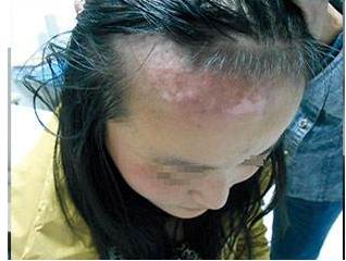 白癜风和甲亢的关系,白癜风与甲亢产生交集