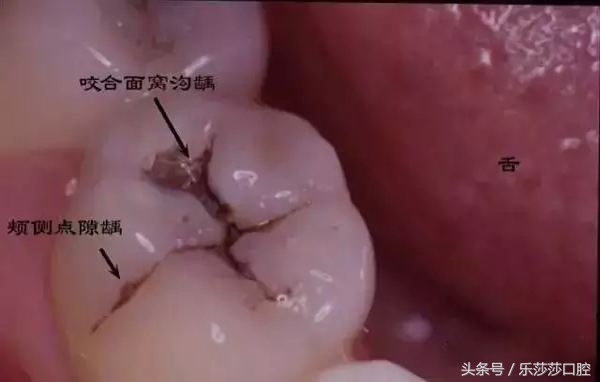 大牙上有黑线是怎么回事,孩子大牙上有黑线怎么办