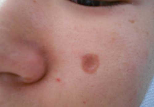 为什么说靠药品去除不了胎记