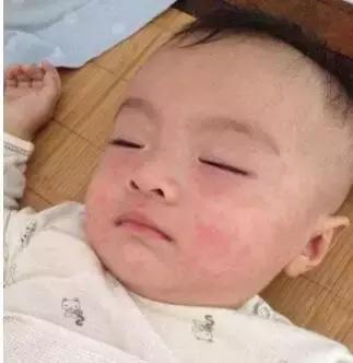 疹子幼儿急疹,水痘幼儿急疹