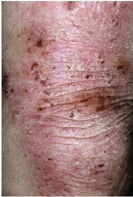 孩子湿疹吃什么药,8岁孩子湿疹