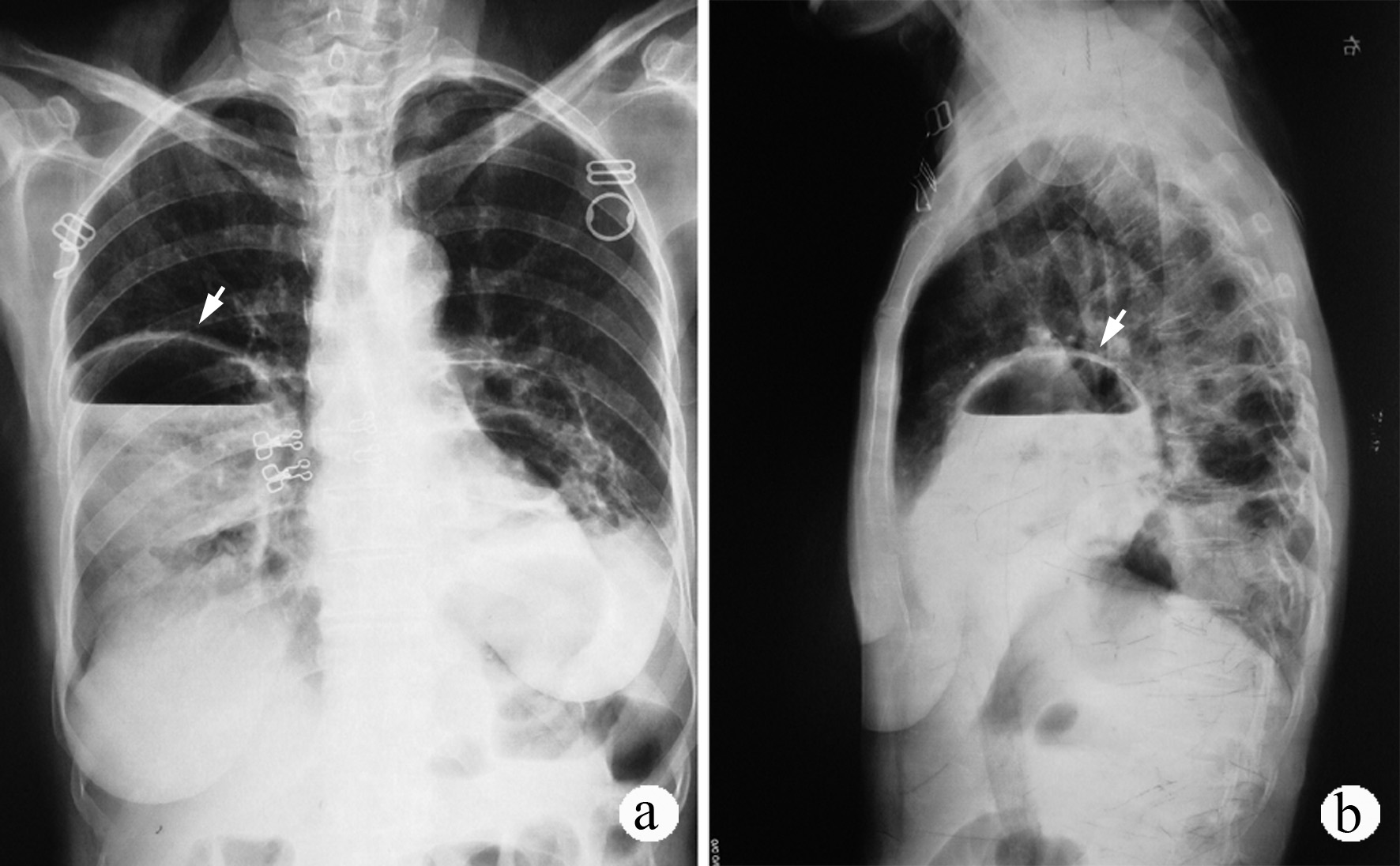 引起肺癌的三大主要原因,诱发肺癌的原因