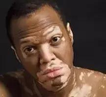 白癜风医学上有没有新进展,白癜风治疗方法的发展趋势