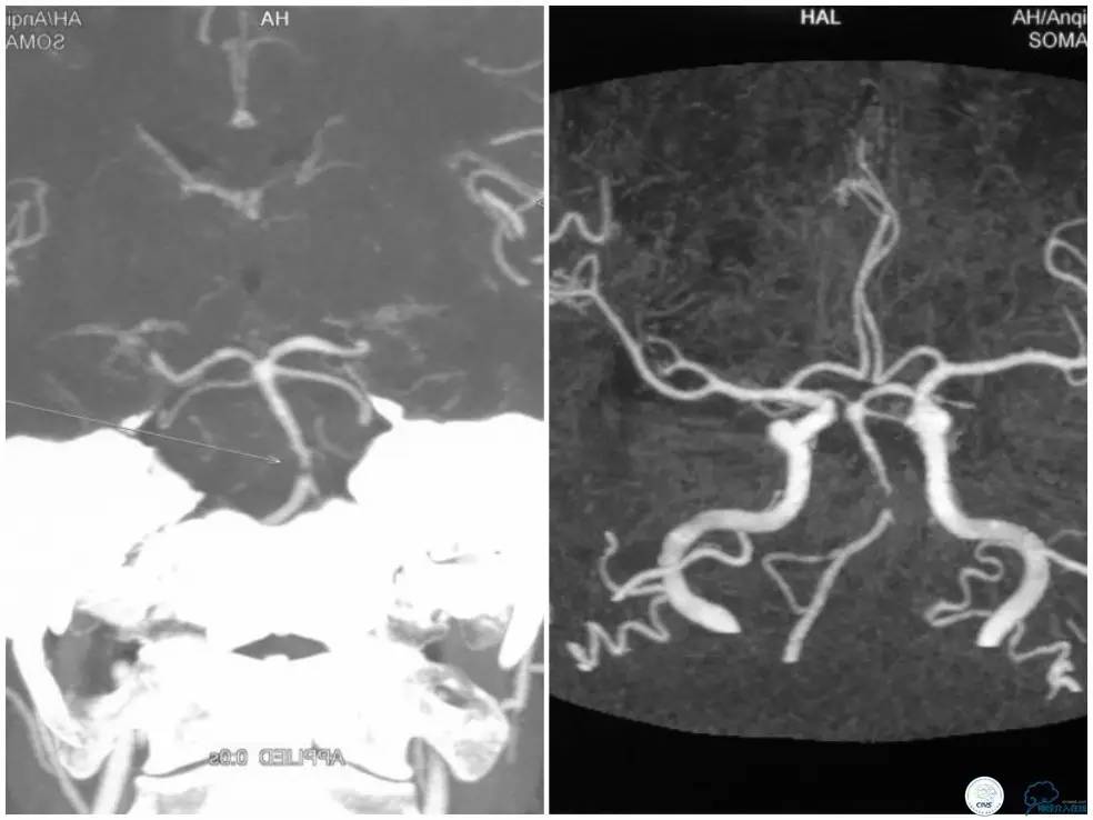 天坛医院基底动脉,天坛医院脑血管支架费用高吗