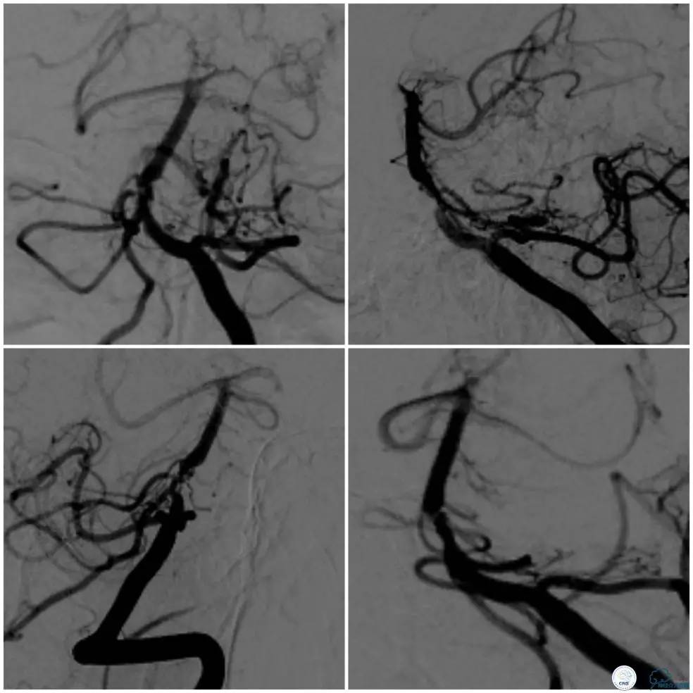 天坛医院基底动脉,天坛医院脑血管支架费用高吗