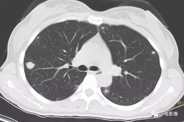 绒毛膜癌转移到脑,绒毛膜癌肺转移
