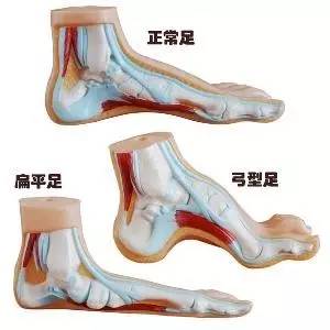 如何预防跑步跟腱炎,打篮球怎么预防跟腱炎