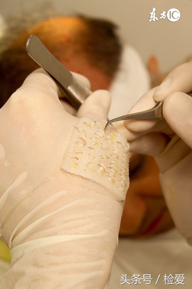 关于植发的8个常识你需要了解,植发安全不