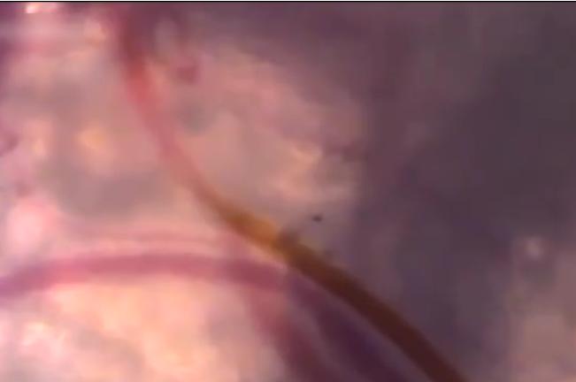 可以吸脂肪的蚊子是真的吗,蚊子抽脂肪吗