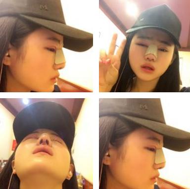 鼻综合7天山根很肿,做完膨体鼻综合修复脸特别肿