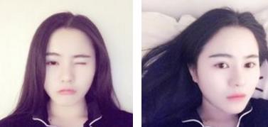 鼻综合7天山根很肿,做完膨体鼻综合修复脸特别肿