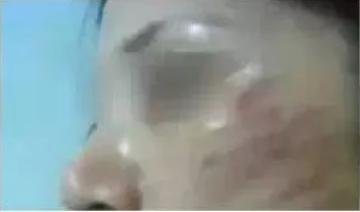 超声刀需要修复吗,超声刀失败怎样修复