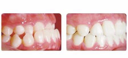 小孩反颌3岁还是4岁矫正比较好,反颌矫正戴牙套多久看得出效果