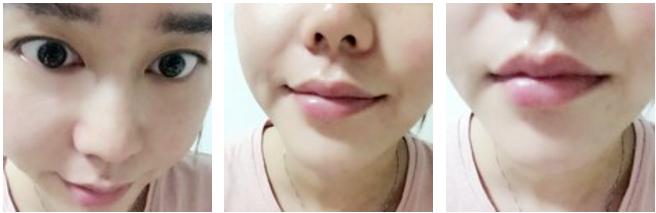 玻尿酸丰唇即刻效果,玻尿酸丰唇有几种唇型