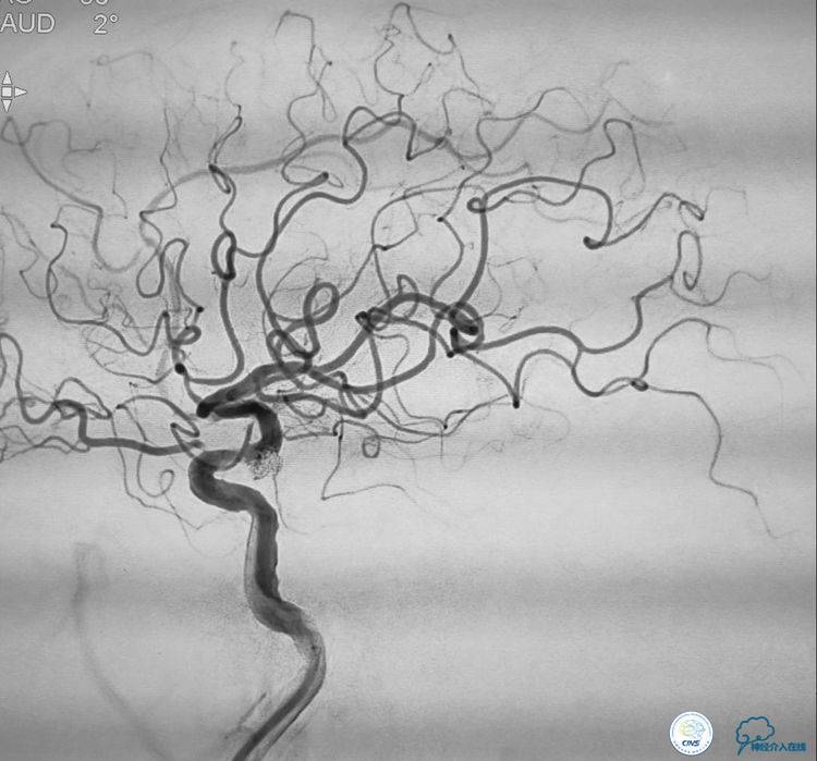 支架辅助弹簧圈栓塞治疗狭窄伴复杂动脉瘤