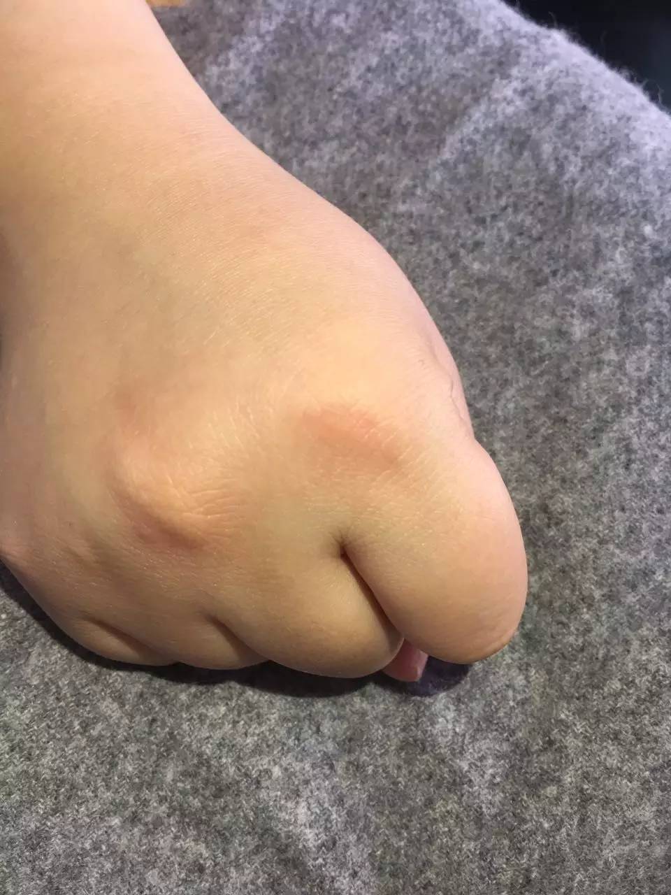 压疮的五大误区,压疮最新指南解读是哪一年的