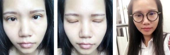 做双眼皮是如何打麻药的,其实做双眼皮没想象中那么疼