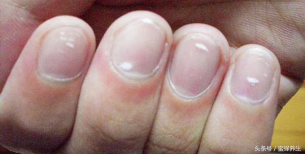 关于指甲那些不得不说的健康事儿