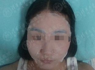 激光祛斑反弹最真实的经历,都说激光祛痘没用是真的吗