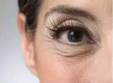 鱼尾纹，这样除最简单，一针即刻见效！