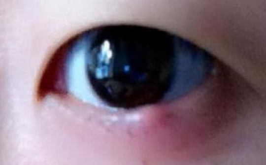 长针眼了怎么热敷,容易长针眼怎么调理