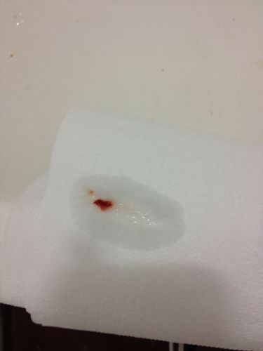 痰中带血究竟是怎么回事呢,痰中带血怎么回事中医