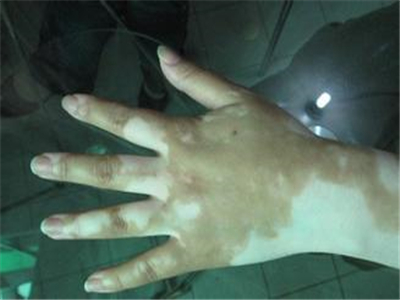 白癜风春季易扩散的原因是什么,白癜风看医生该问些什么