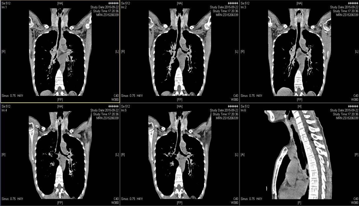 反复咳嗽咳痰气喘5年,长期咳嗽气短久治不愈的原因