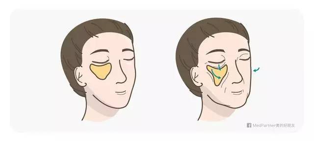 美女与野兽|天生法令纹只能靠整容吗?那是因为你没看这篇!