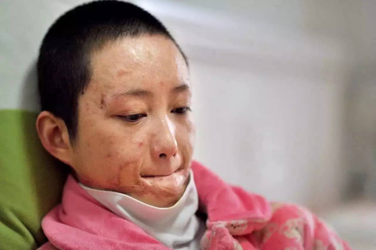 毁容女孩周岩做康复过程,毁容少女周岩4年半励志蜕变