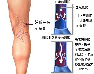 腿上血管凸起还疼是怎么回事,腿弯发痒一抓起一片疙瘩怎么回事