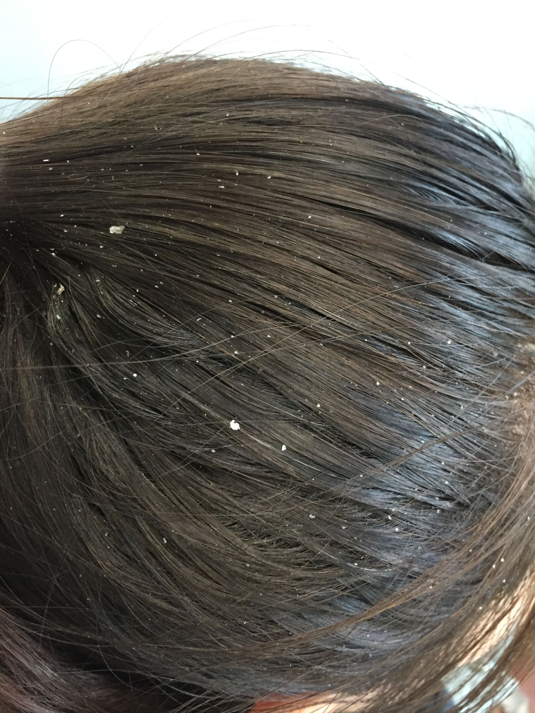 头皮脂溢性皮炎一般多久能治愈,头皮脂溢性皮炎怎么彻底治愈