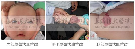 治疗血管瘤的最好医生,郭先锋谈血管瘤饮食禁忌