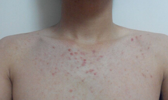 胸前长了很多红色的点点用什么药,胸前长小点点
