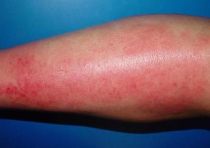 胳膊肿了导致手麻怎么回事,胳膊肿了摸着里面有个疙瘩