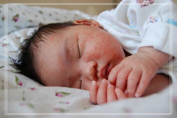 如何根治宝宝反复发作的湿疹问题,宝宝得了湿疹的最佳治疗方法