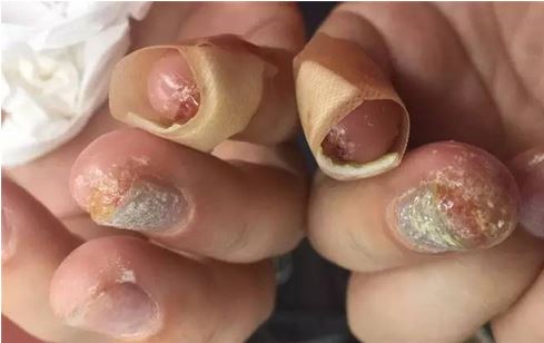 姑娘被拔手指甲,四根手指不敢做美甲