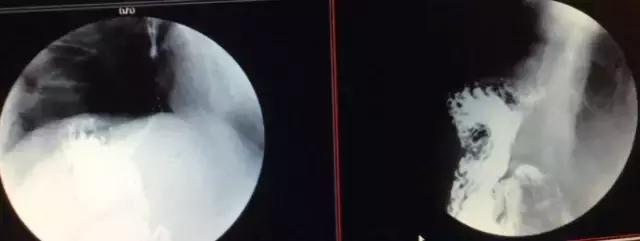 胃底贲门中分化腺癌怎么来根治,胃底贲门低中分化腺癌能治愈吗