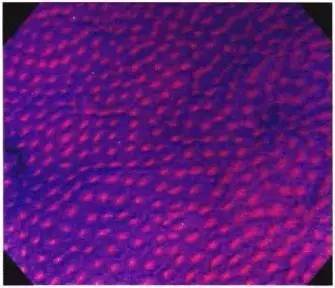 普通内镜与Pitpattern分型（多图详解）