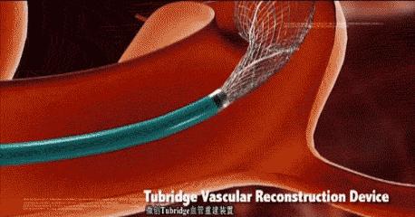 心脏支架后可以吃纳豆激酶吗,心脏支架后可以吃纳豆激酶