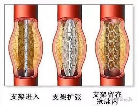 心脏支架后可以吃纳豆激酶吗,心脏支架后可以吃纳豆激酶