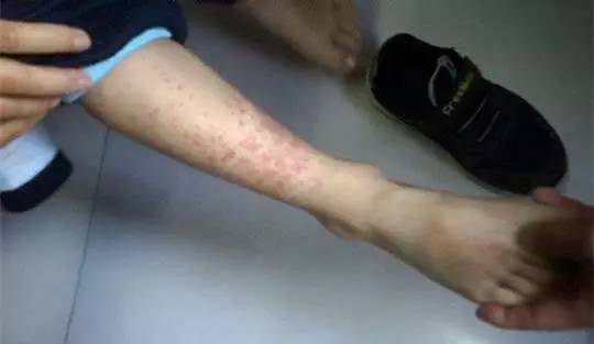 儿科过敏性紫癜个案护理范文,北京西苑治疗过敏性紫癜怎样