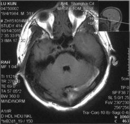 颅内静脉窦血栓怎么治疗,颅内静脉窦血栓造影多少钱