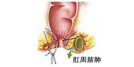 抽烟和喝酒哪个对痔疮危害大,痔疮时间久了不割会有哪些危害