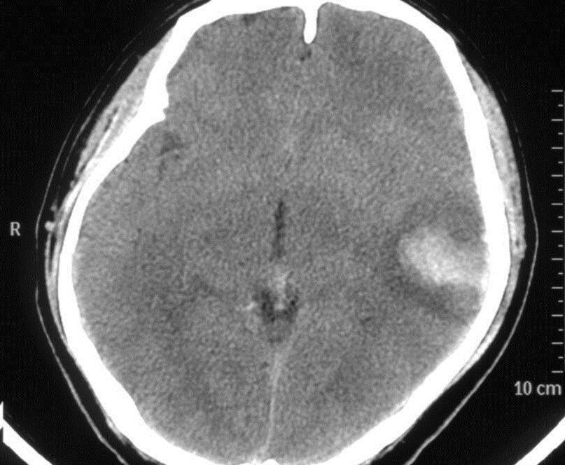 颅内静脉窦血栓怎么治疗,颅内静脉窦血栓造影多少钱
