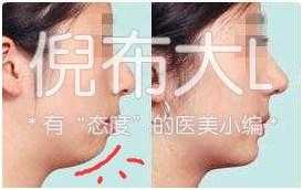 垫下巴鉴定,垫下巴看得出来吗