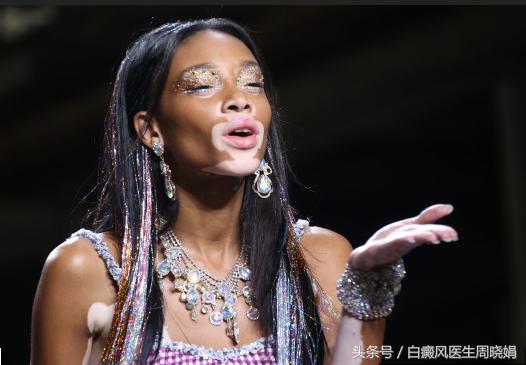 白癜风明星有哪些,白癜风明星