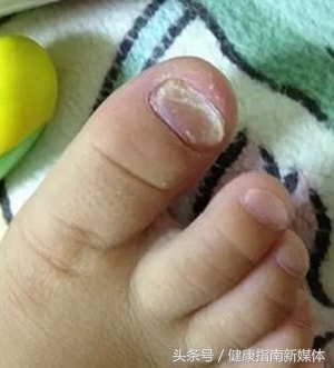 宝宝会得灰指甲什么样子,宝宝指甲像灰指甲怎么办