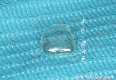 乳前牙透明冠修复大概要多久,乳前牙透明冠操作流程